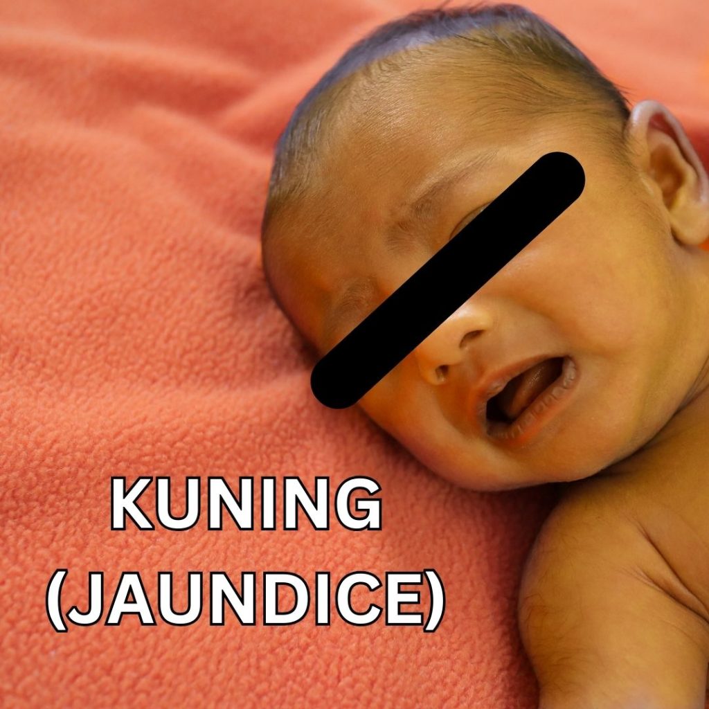 Pemeriksaan kuning bayi (jaundice) tanpa jarum di Nur Mediklinik Tawau Sabah